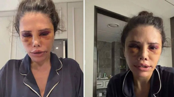 Didem Ceran estetik ameliyatını anlattı