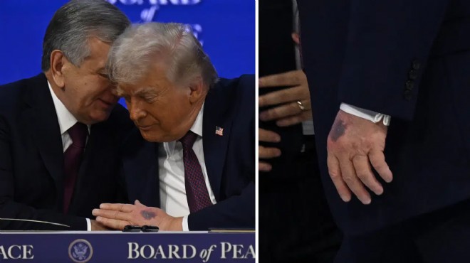 Trump'ın elindeki morluğun nedeni belli oldu